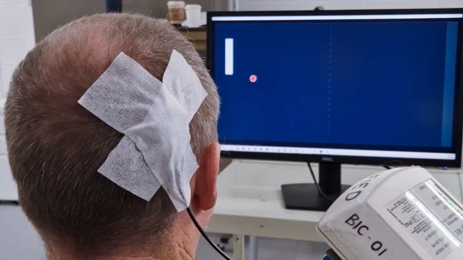 CorTec's Brain Interchange&trade; BCI System Enables Stroke Patient to Control Computer with his Mind